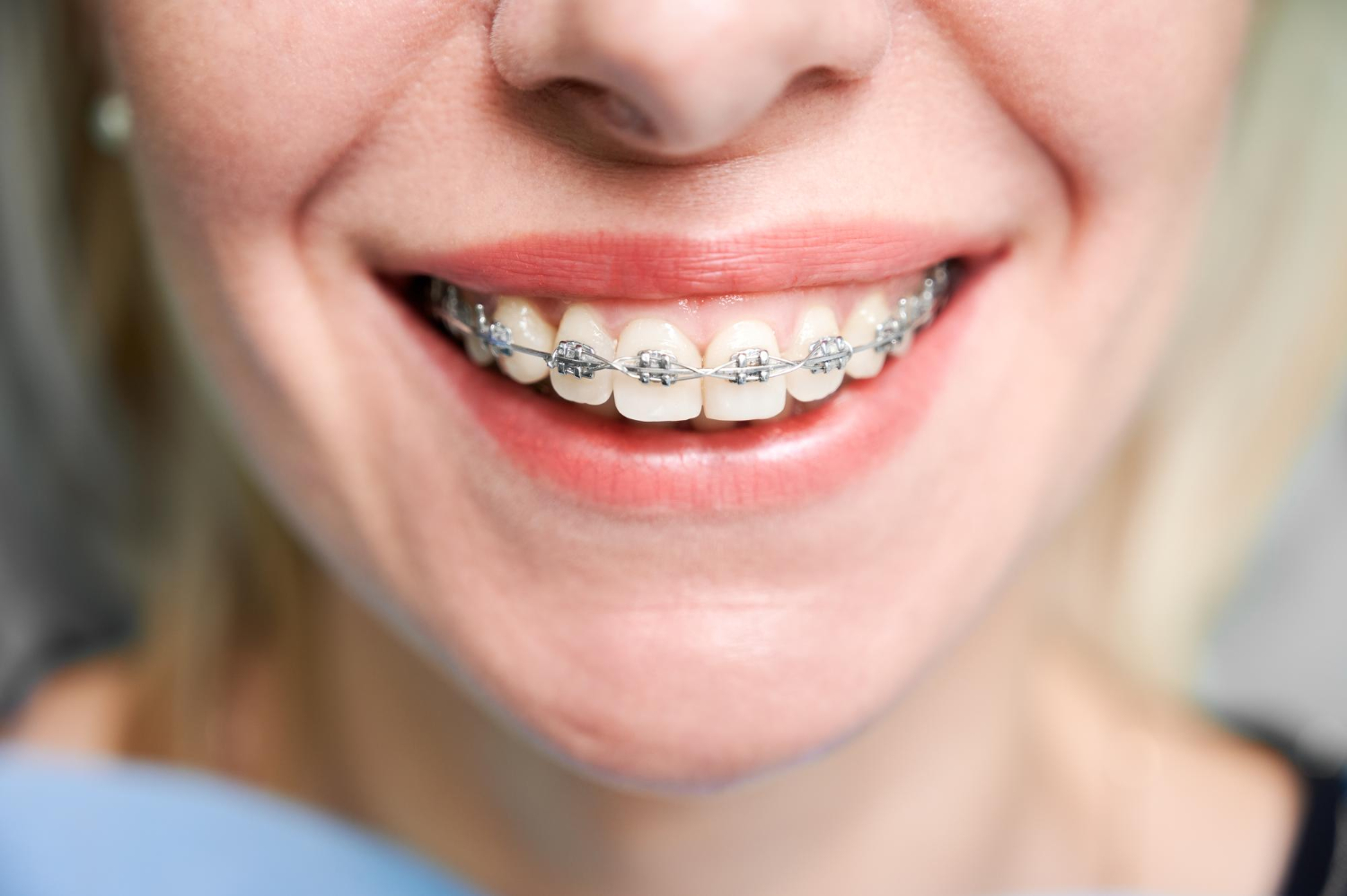 Bądź piękna – idź do ortodonty
